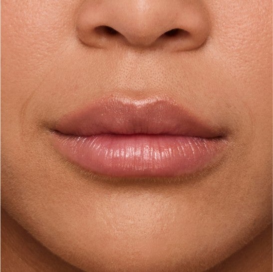 Image of a model before and after treatment with the JUVÉDERM Collection of Fillers. 