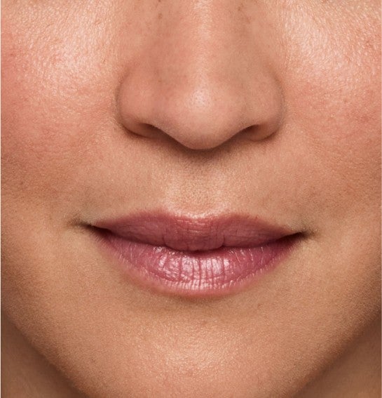 Image of a model before and after treatment with the JUVÉDERM Collection of Fillers. 