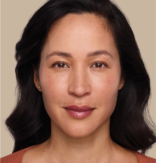 Image of a model before and after treatment with the JUVÉDERM Collection of Fillers. 