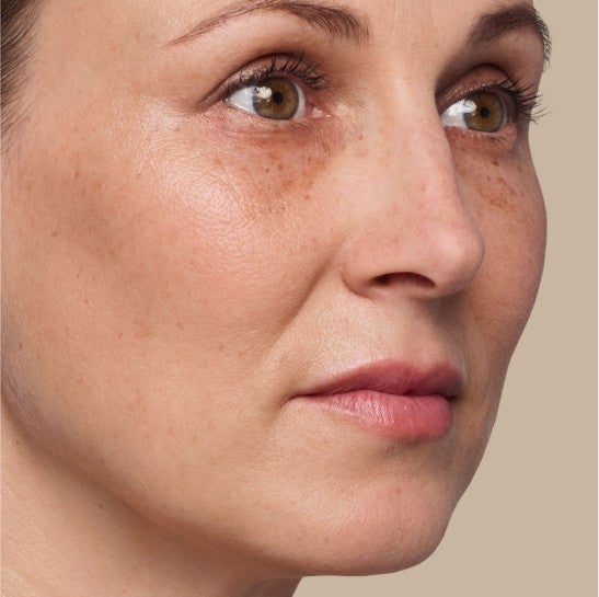 Image of a model before and after treatment with the JUVÉDERM Collection of Fillers. 