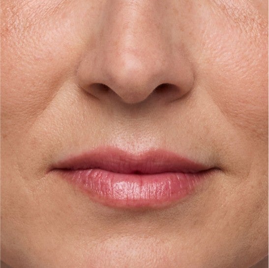 Image of a model before and after treatment with the JUVÉDERM Collection of Fillers. 