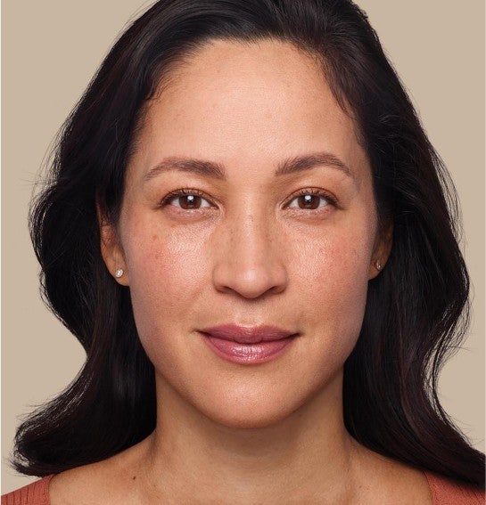 Image of a model before and after treatment with the JUVÉDERM Collection of Fillers. 