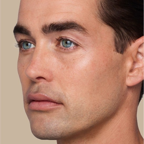 Image of a model before and after treatment with the JUVÉDERM Collection of Fillers. 