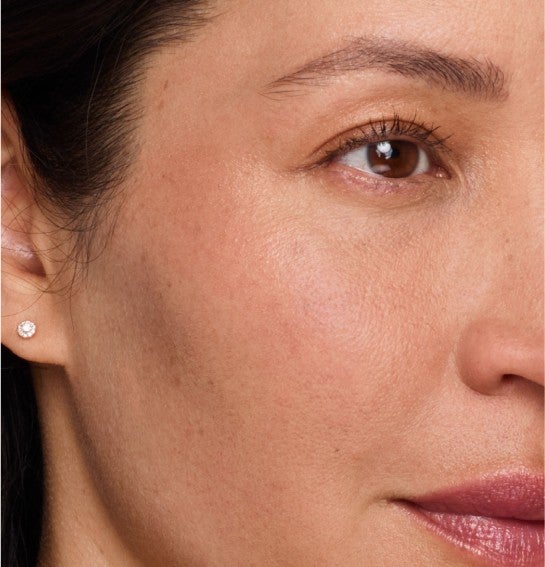 Image of a model before and after treatment with the JUVÉDERM Collection of Fillers. 