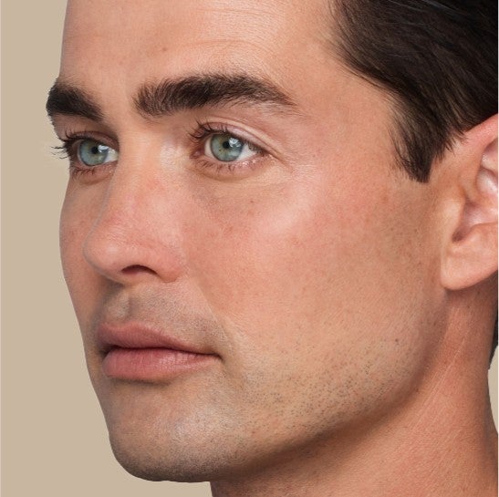 Image of a model before and after treatment with the JUVÉDERM Collection of Fillers. 