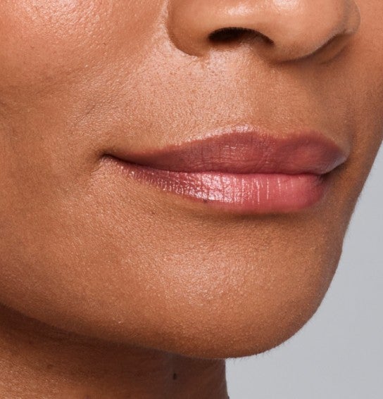 Image of a model before and after treatment with the JUVÉDERM Collection of Fillers. 