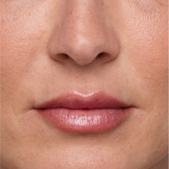 Image of a model before and after treatment with the JUVÉDERM Collection of Fillers. 