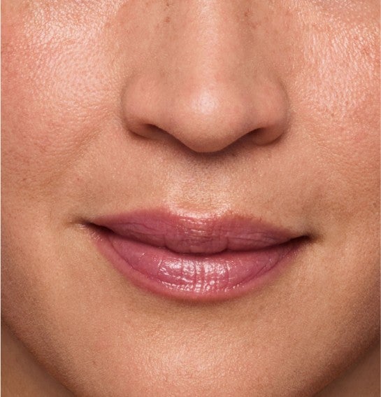 Image of a model before and after treatment with the JUVÉDERM Collection of Fillers. 