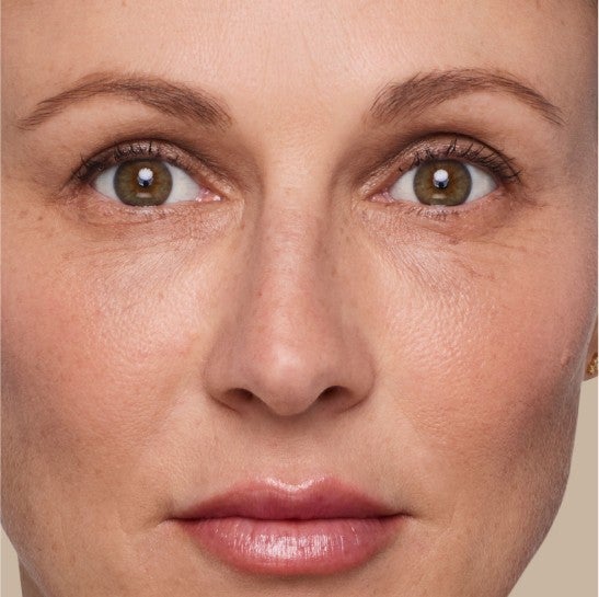 Image of a model before and after treatment with the JUVÉDERM Collection of Fillers. 