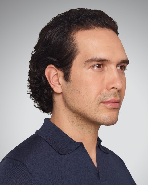 DEVIN - cheeks, lips, undereye, lines & jawline After Juvederm