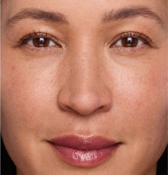 Image of a model before and after treatment with the JUVÉDERM Collection of Fillers. 