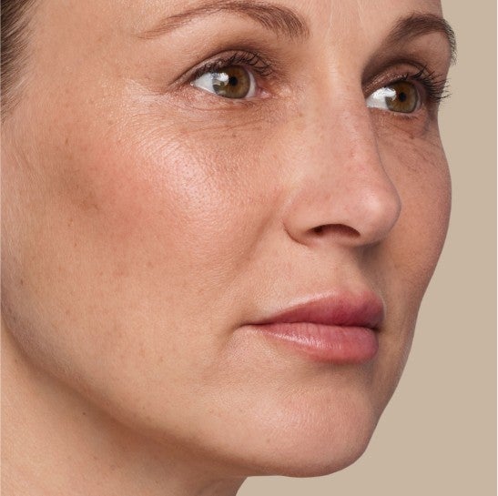 Image of a model before and after treatment with the JUVÉDERM Collection of Fillers. 