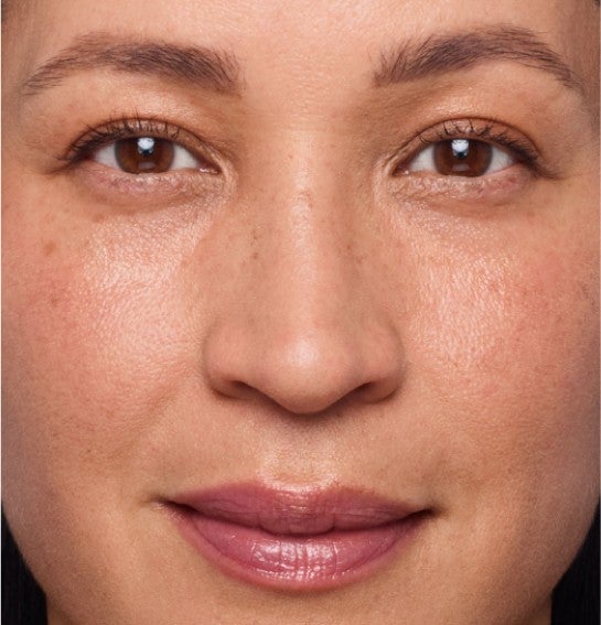 Image of a model before and after treatment with the JUVÉDERM Collection of Fillers. 